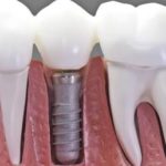 Dental Implant setup