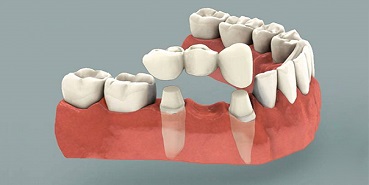 Dental Bridge treatment in Bibwewadi