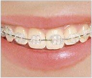 Braces Treatment