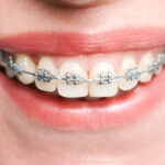 Find Best Braces Treatment in Bibwewadi