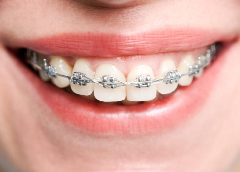 Find Best Braces Treatment in Bibwewadi
