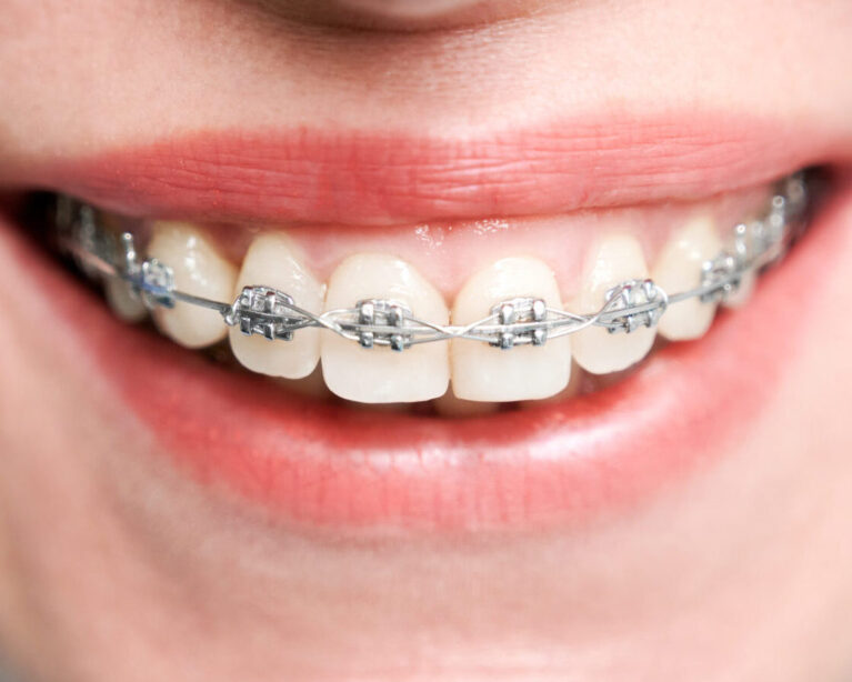 Find Best Braces Treatment in Bibwewadi