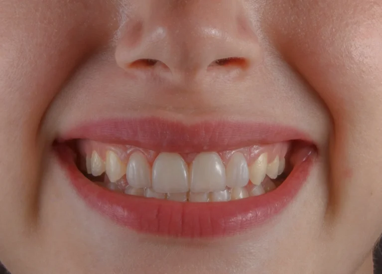 Get Safe Teeth Whitening Treatment In Pune