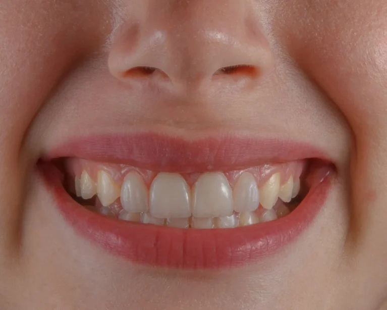 Get Safe Teeth Whitening Treatment In Pune