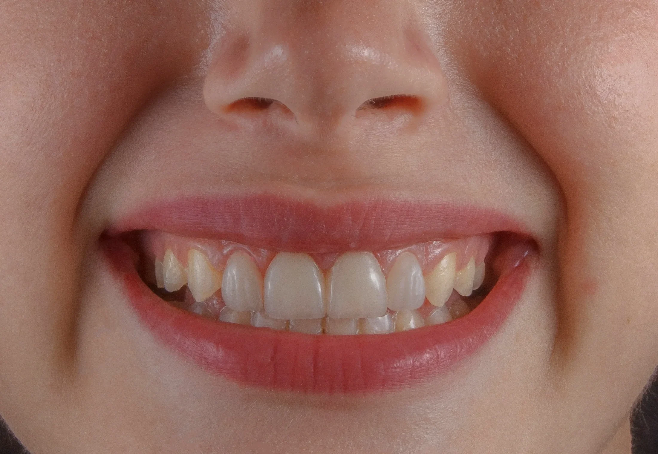 Get Safe Teeth Whitening Treatment In Pune