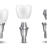 Dental Implant procedure at Kotadias Dental Clinic Bibwewadi