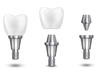 Dental Implants vs. Bridges – Which is Better in Bibwewadi?
