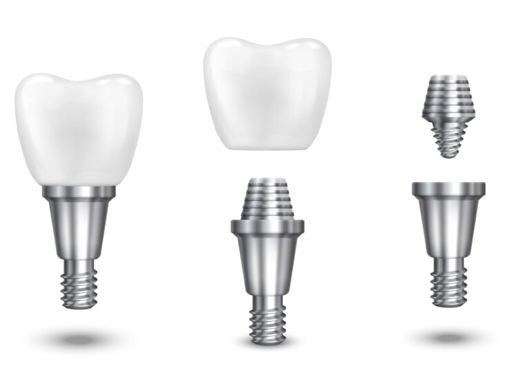 Dental Implant procedure at Kotadias Dental Clinic Bibwewadi