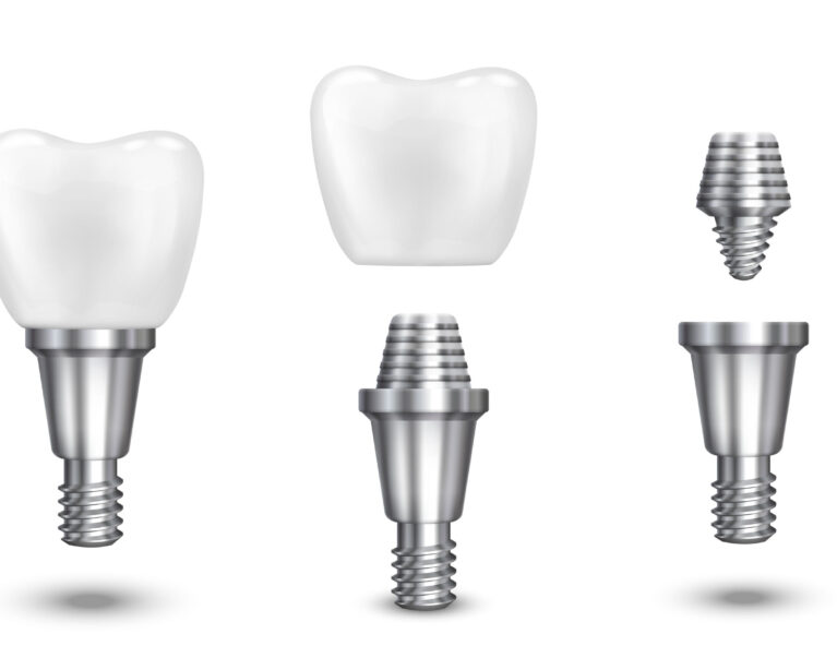 Dental Implant procedure at Kotadias Dental Clinic Bibwewadi