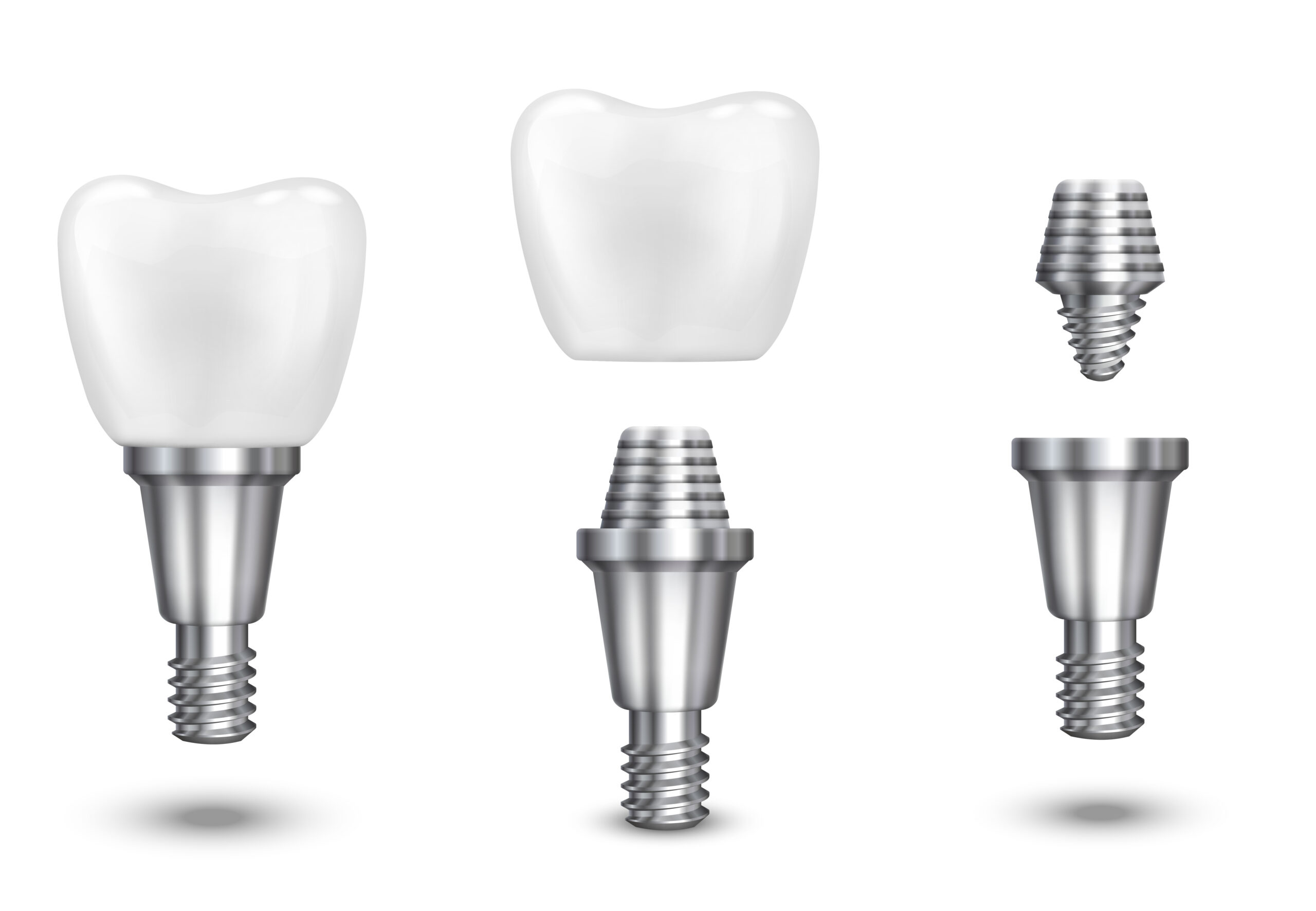 Dental Implant procedure at Kotadias Dental Clinic Bibwewadi