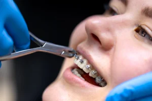 Find Dental Braces Treatment in Bibwewadi
