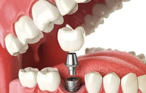 Find Dental Implant in Bibwewadi