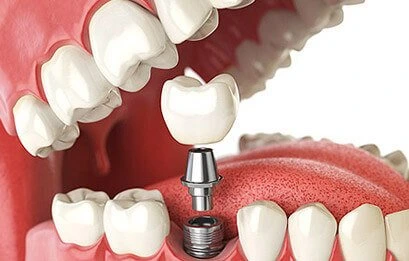 Find Dental Implant in Bibwewadi