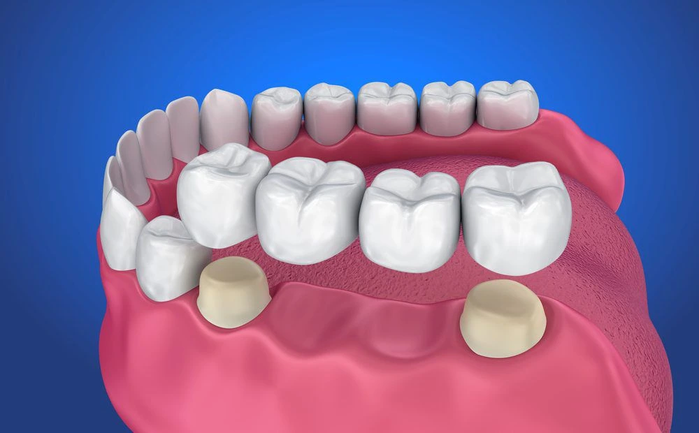 Find Dental Bridge treatment in Bibwewadi.