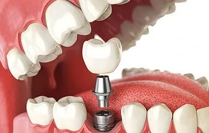 Find Dental Implant Services Pune Bibwewadi.
