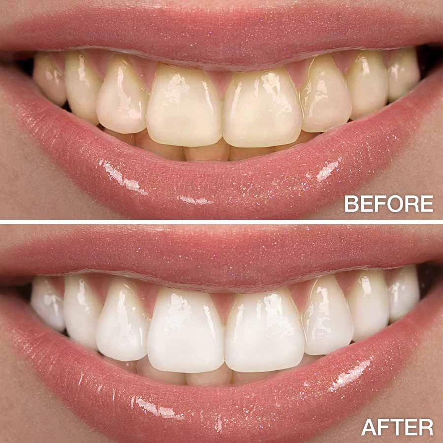 Search Teeth Whitening Treatment in Bibwewadi.