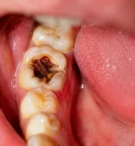 Dentist examining infected tooth X-ray before root canal treatment in Pune