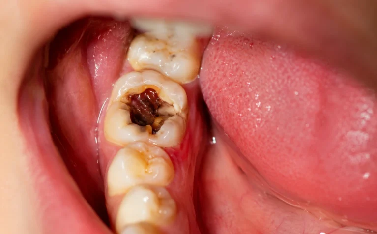 Dentist examining infected tooth X-ray before root canal treatment in Pune