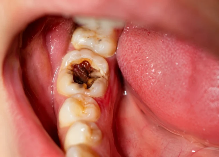 Dentist examining infected tooth X-ray before root canal treatment in Pune