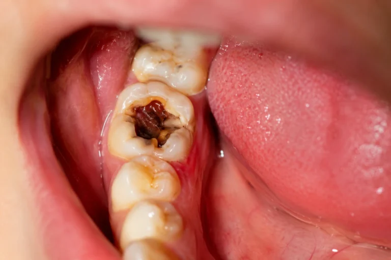 Dentist examining infected tooth X-ray before root canal treatment in Pune
